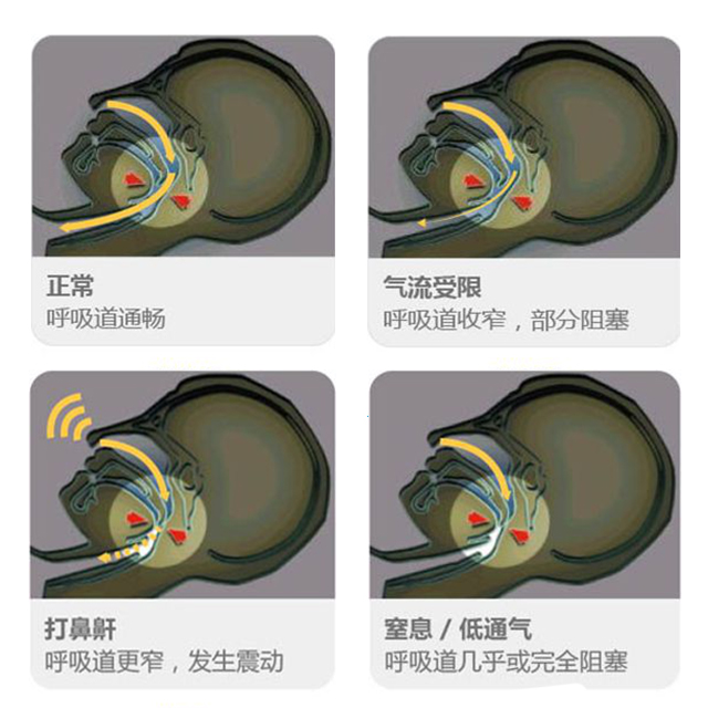 什么是睡眠呼吸暂停及呼吸暂停分类